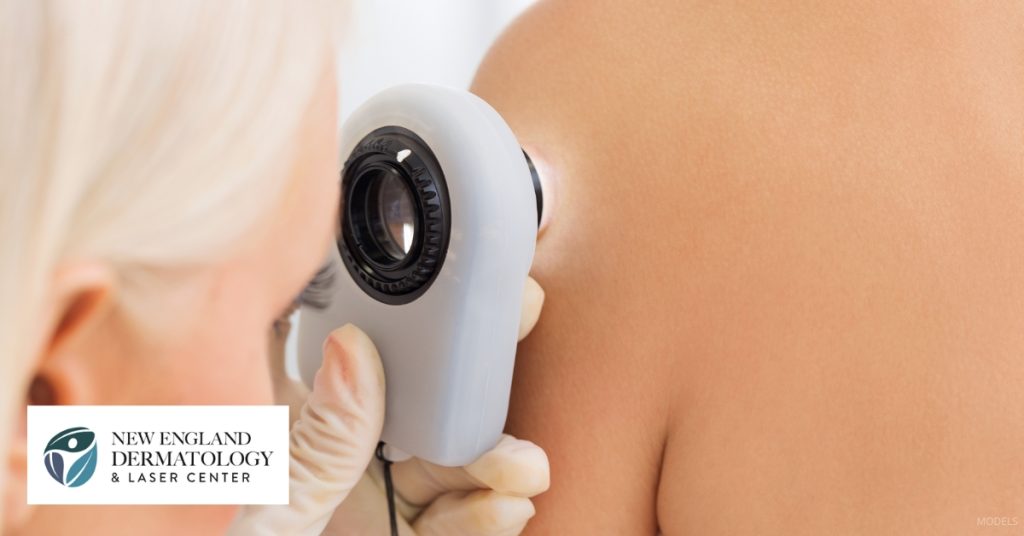 Dermatologist checking a patient (MODELS) for skin cancer